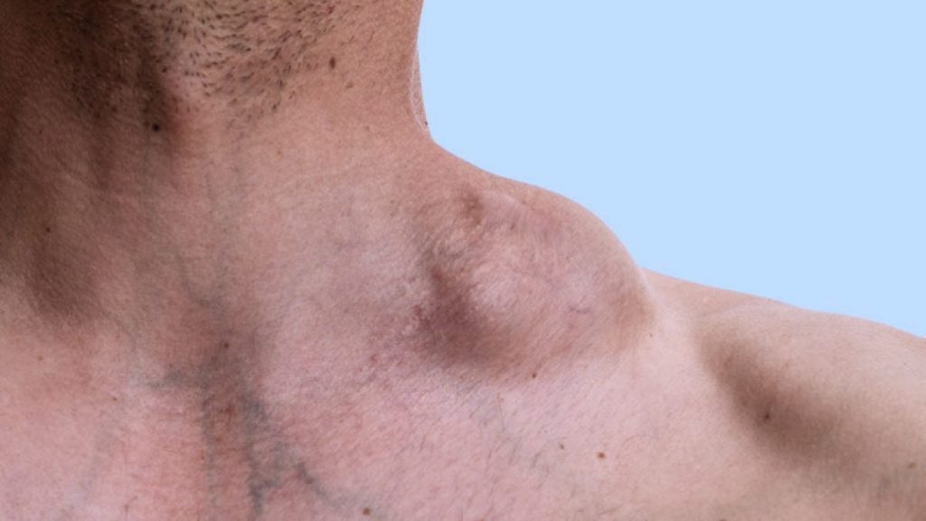 O que é Linfoma? entenda quais os sintomas, causas e tratamento