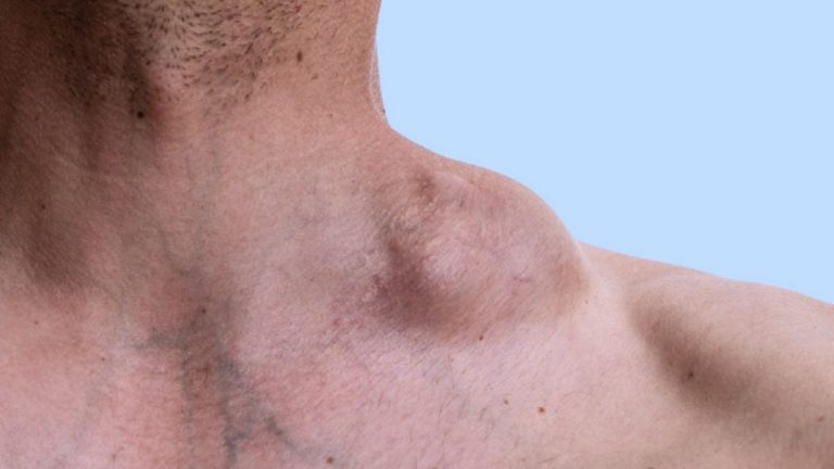O que é Linfoma? entenda quais os sintomas, causas e tratamento